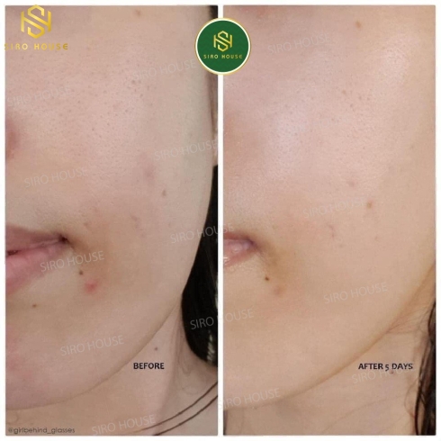 Kem trị mụn TEZARONE Gel 0.3% Medisun 10g
