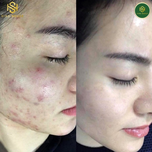 Gel giảm mụn SANTAGIFT SPF 30 3 In 1 Skin Care Gel (20g)