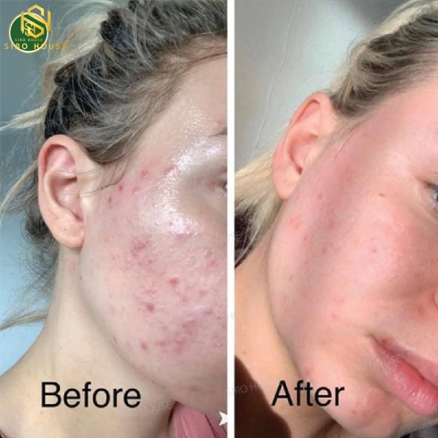 Sữa Rửa Mặt CERAVE Acne Control Cleanser (237ml)