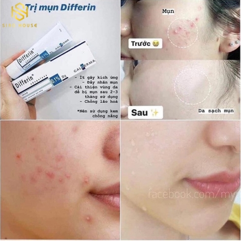 Kem Trị Mụn Differine Adapalene Cream 0.1% Acne Treatment