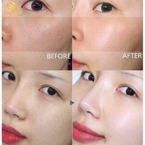 NƯỚC HOA HỒNG TRỊ NÁM DONGSUNG RANNCE SKIN (130ML)