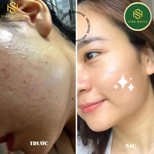 Lotion chấm mụn chứa 5% Benzoyl Peroxide Obagi CLENZIderm MD Therapeutic