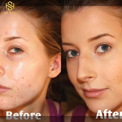 Kem trị chống lão hóa, trị mụn OBAGI Tretinoin Cream 0.025% 20g