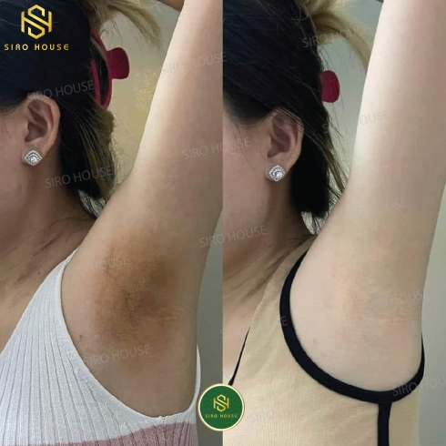 Kem trị thâm nách Q-NIC Care Thái Lan 