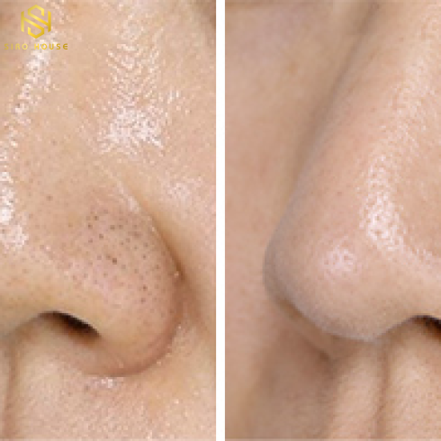 Thanh Lăn Mụn Đầu Đen MAMONDE Pore Clean Blackhead Stick