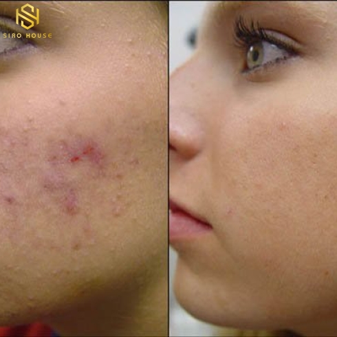 Kem trị chống lão hóa, trị mụn OBAGI Tretinoin Cream 0.1% 20g