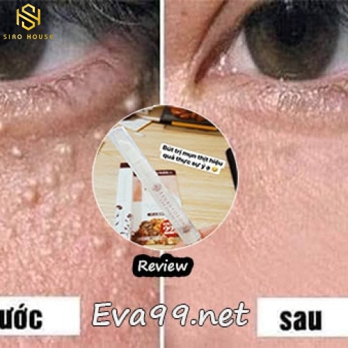 KEM TRỊ MỤN THỊT VÙNG MẮT TSUBUPORON EYE ESSENCE