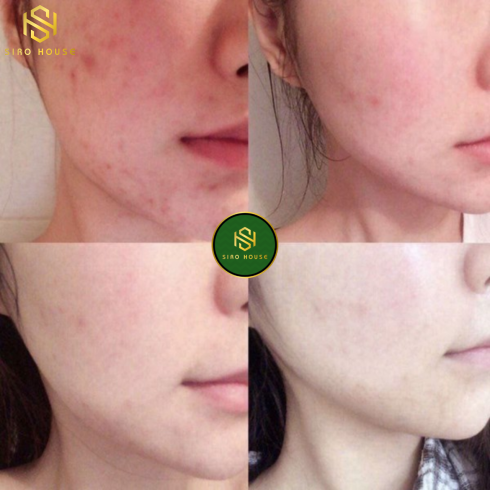 Sữa rửa mặt NARUKO Tea Tree Clay & Mask (120g)