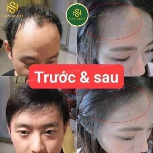 Dung dịch mọc tóc, ngăn rụng tóc BAILLEUL Minoxidil 2% (Hộp 3 x 60mL)