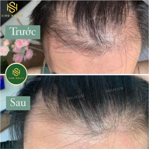 Dung dịch mọc tóc, ngăn rụng tóc BAILLEUL Minoxidil 2% (Hộp 3 x 60mL)