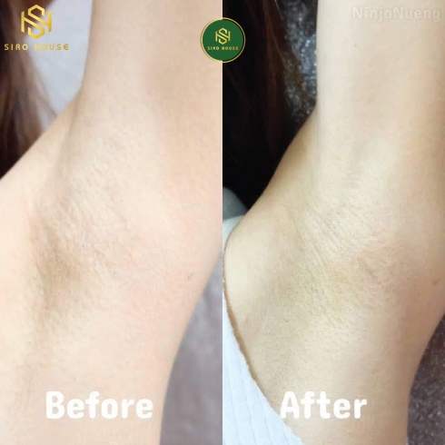 Kem giảm thâm nách Q-Nic Care Whitening Underarm Cream 15g 