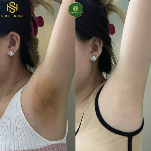 Kem giảm thâm nách Q-Nic Care Whitening Underarm Cream 15g 