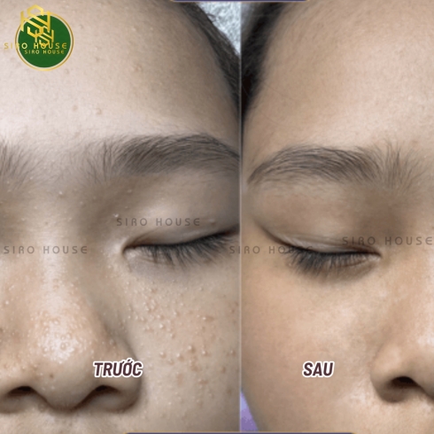 Bút trị mụn thịt TSUBUPORON Eye Essence 1.8mL