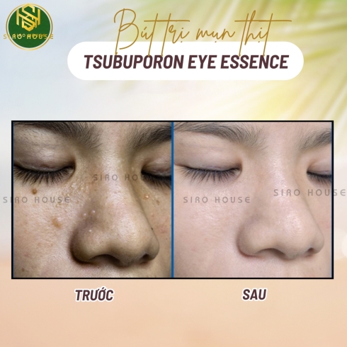 Bút trị mụn thịt TSUBUPORON Eye Essence 1.8mL