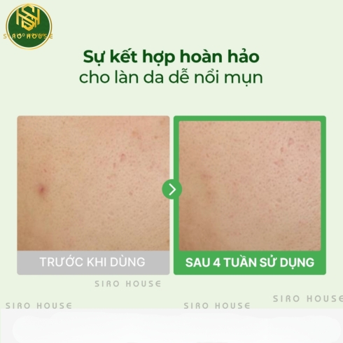 Tinh chất cấp ẩm, phục hồi da TORRIDEN Balanceful Serum 50mL