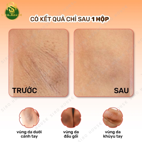 Kem trị thâm nách S88 Total White 35g 
