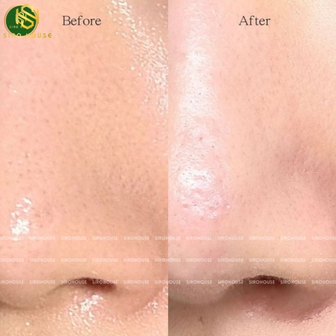 Tinh chất ủ mụn đầu đen ILSO Sebum Super Melting Serum Softener 150mL