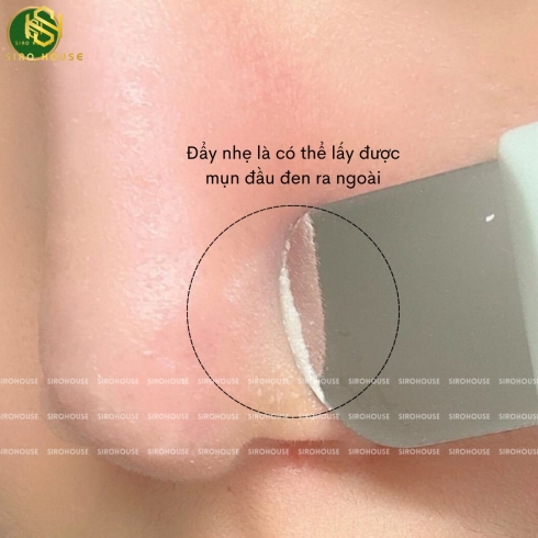 Thanh đẩy mụn đầu đen và bã nhờn ILSO