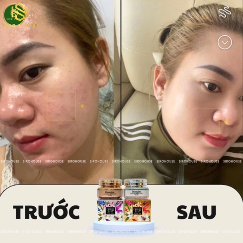 Kem dưỡng ngừa nám, tàn nhang DEMEJINE ngày-đêm 20g
