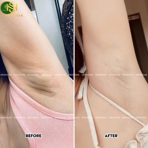 Kem trị thâm nách ALPHA ARBUTIN 3 Plus Collagen Underarm Night Cream 50g