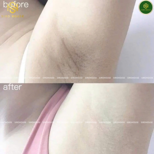 Kem trị thâm nách ALPHA ARBUTIN 3 Plus Collagen Underarm Night Cream 50g