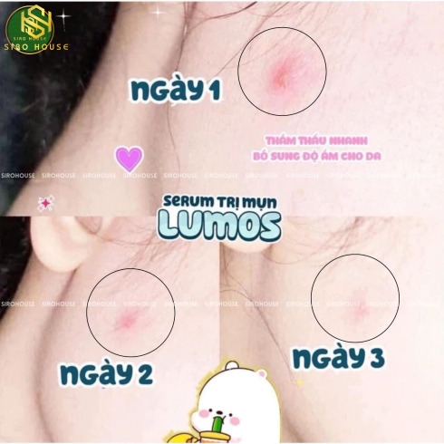 Serum trị mụn, mờ thâm LUMOS Acne 5mL