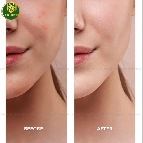 Gel đặc trị mụn, trẻ hoá da OBAGI Tretinoin Gel 0.05% 20g 