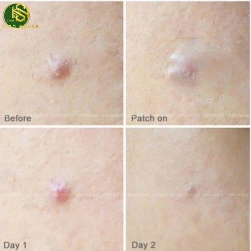 Miếng dán mụn CNP Laboratory Anti-Blemish Spot Patch 72 miếng 