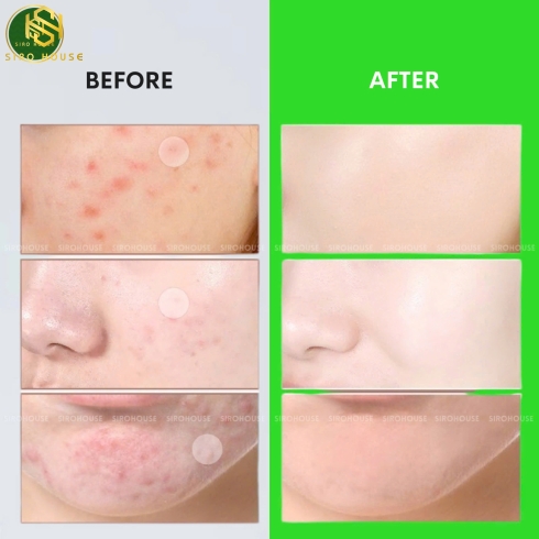 Miếng dán mụn CNP Laboratory Anti-Blemish Spot Patch 72 miếng 
