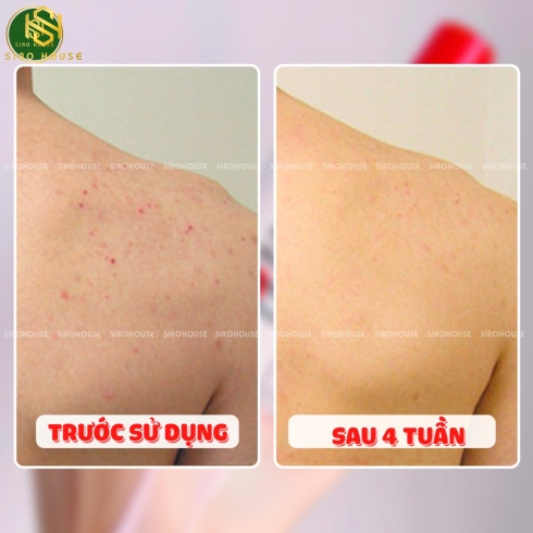 Sữa dưỡng thể trắng da, ngừa mụn TIA
