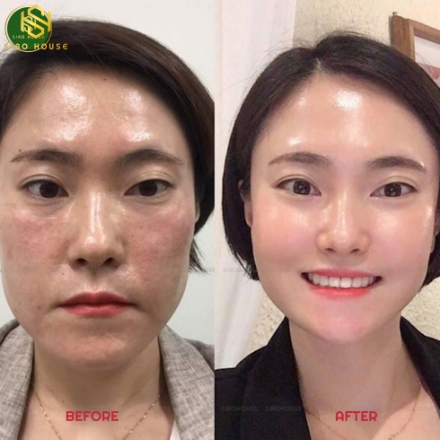 Tinh chất peel da tái tạo chuyên sâu CNP Rx Skin Rejuvenating Intensive Peel 2mL