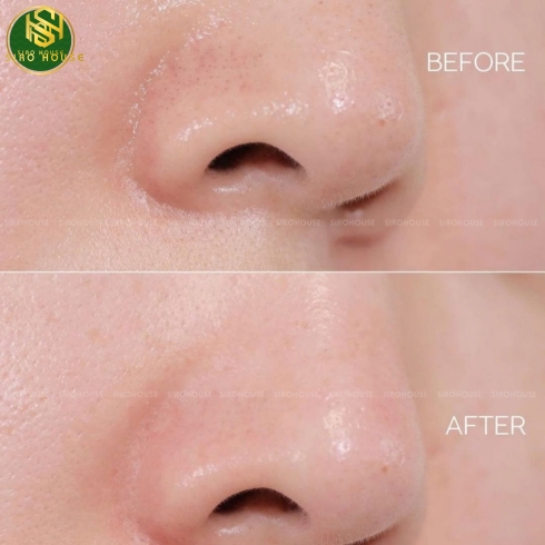 Ủ mụn ILSO Melting Sebum Softener 150g + 40 Bông