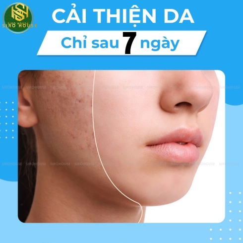 	Gel trị mụn EPIDUO 0.1%/2.5% gel 15g	