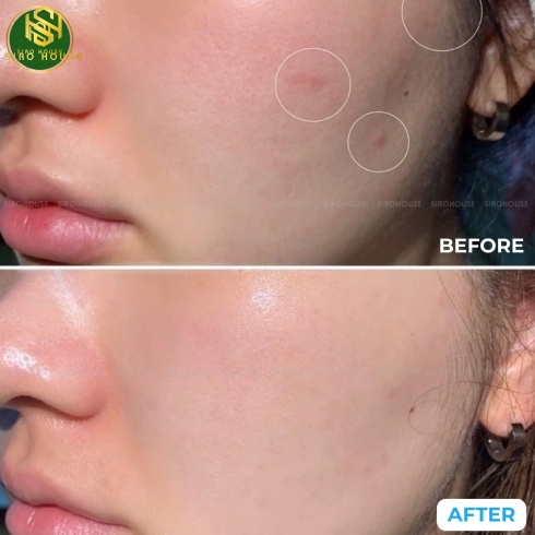 	Gel trị mụn EPIDUO 0.1%/2.5% gel 15g	