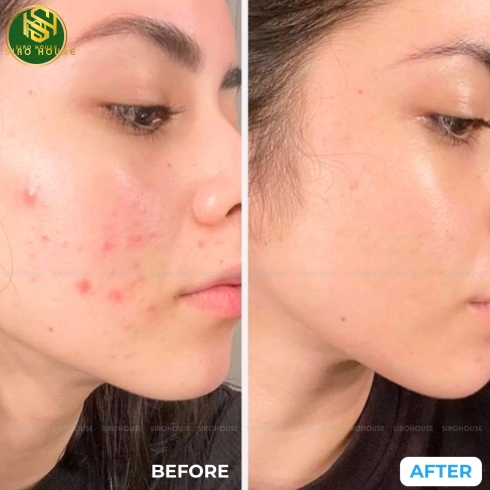 	Gel trị mụn EPIDUO 0.1%/2.5% gel 15g	