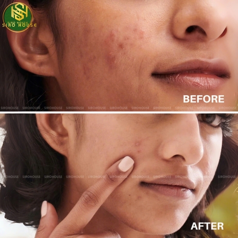 Sữa rửa mặt NEUTROGENA Oil-Free Acne Wash bưởi hồng 198ml