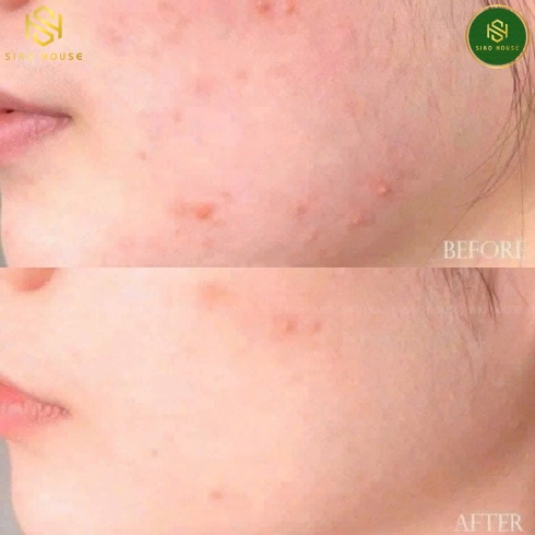 Sữa rửa mặt DERMACOS Anti-Acne Deep Cleansing Gel 150mL