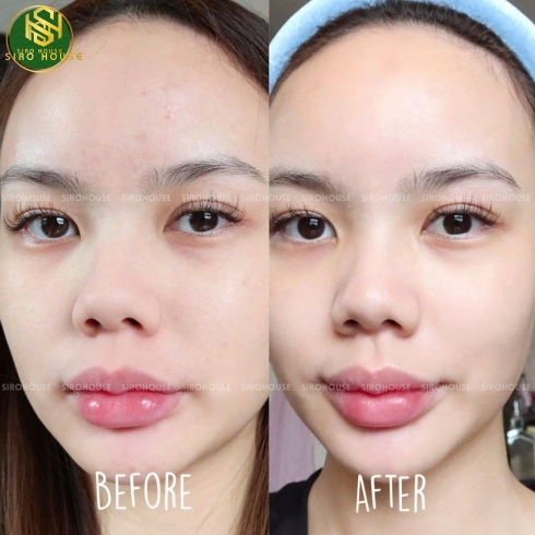 Bộ 3 sản phẩm rửa mặt ACNES 100g