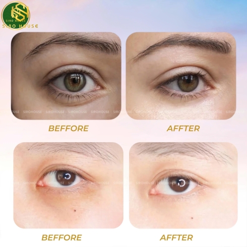 Kem dưỡng mắt LANCÔME Advanced Génifique Yeux 15ml & 20ml 
