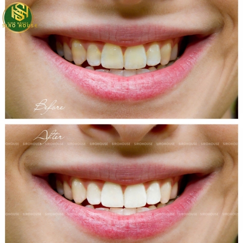 Kem đánh răng AQUAFRESH Whitening Action & Cavity Protection 158.7g