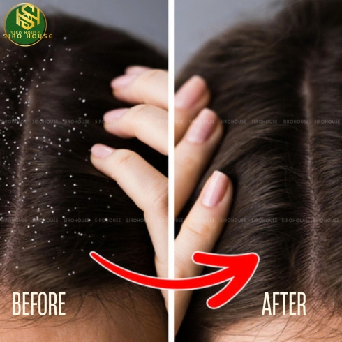 Dầu Gội Trị Gàu SELSUN BLUE 325mL (Cleanse & Conditions 2-in-1, Medicated, Itchy Dry Scalp, Moisturizing with Aloe, Naturals Itchy Dry Scalp)